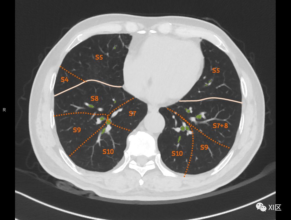 如此详细的肺部影像解剖，有点儿酷！