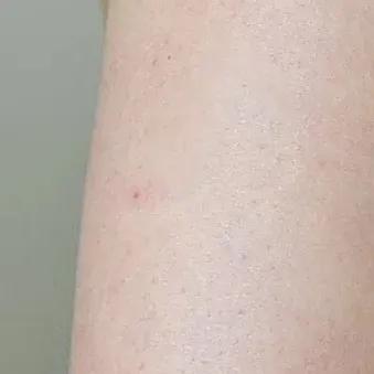 又到了穿小裙的季节，鸡皮女孩该怎么办……