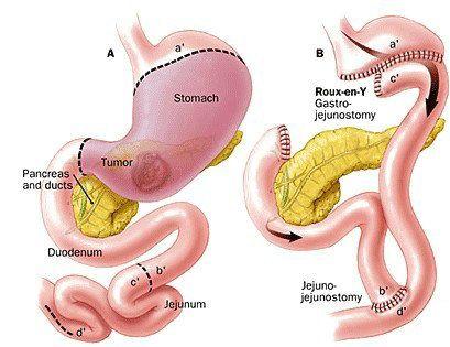 调理肠胃胃酸最简单的方法,胃酸过多怎么改善