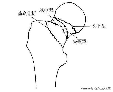老年人股骨颈骨折会股骨头坏死吗,老年人股骨头摔断能治愈吗