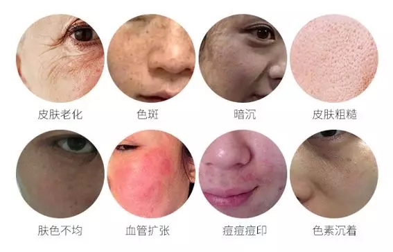 opt王者之冠和m22区别,opt面部提升注意事项