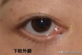 做眼袋提眉眼睑外翻怎么办,祛眼袋眼睑轻度外翻悬吊多久能好