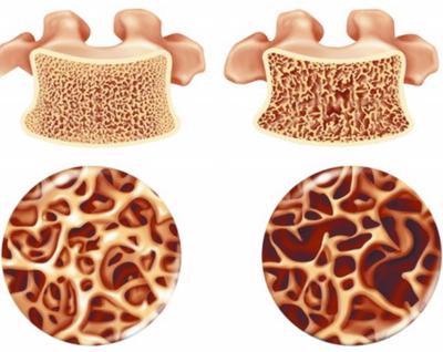 腰部酸胀热敷可以缓解是什么原因,左侧腰部疼痛连着左腿怎么缓解
