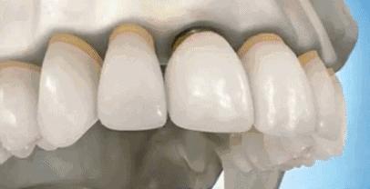 假牙松动重新粘合需要多少钱,种植牙松动可以拔掉重新种吗