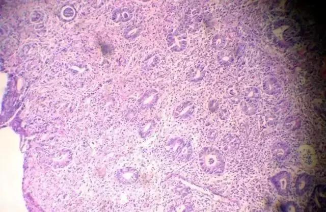 如何看懂胃镜活检报告,胃镜病理活检报告一般需几天