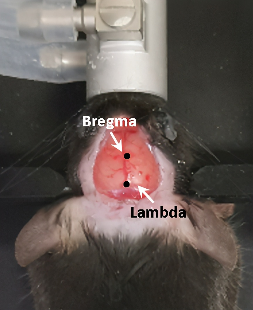 晶体植入手术的分享,可调微丝阵列电极