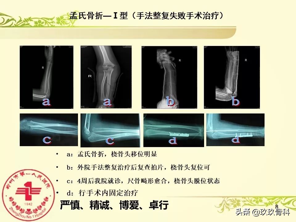 孟氏骨折功能训练多久能恢复正常,孟氏骨折中医能治吗