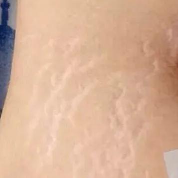 又到了穿小裙的季节，鸡皮女孩该怎么办……