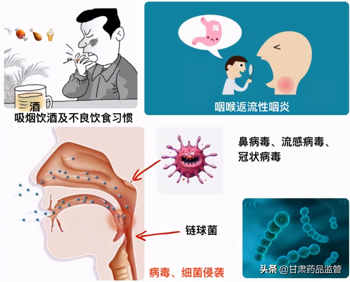 科普|揭秘咽炎真相，合理用药有门道