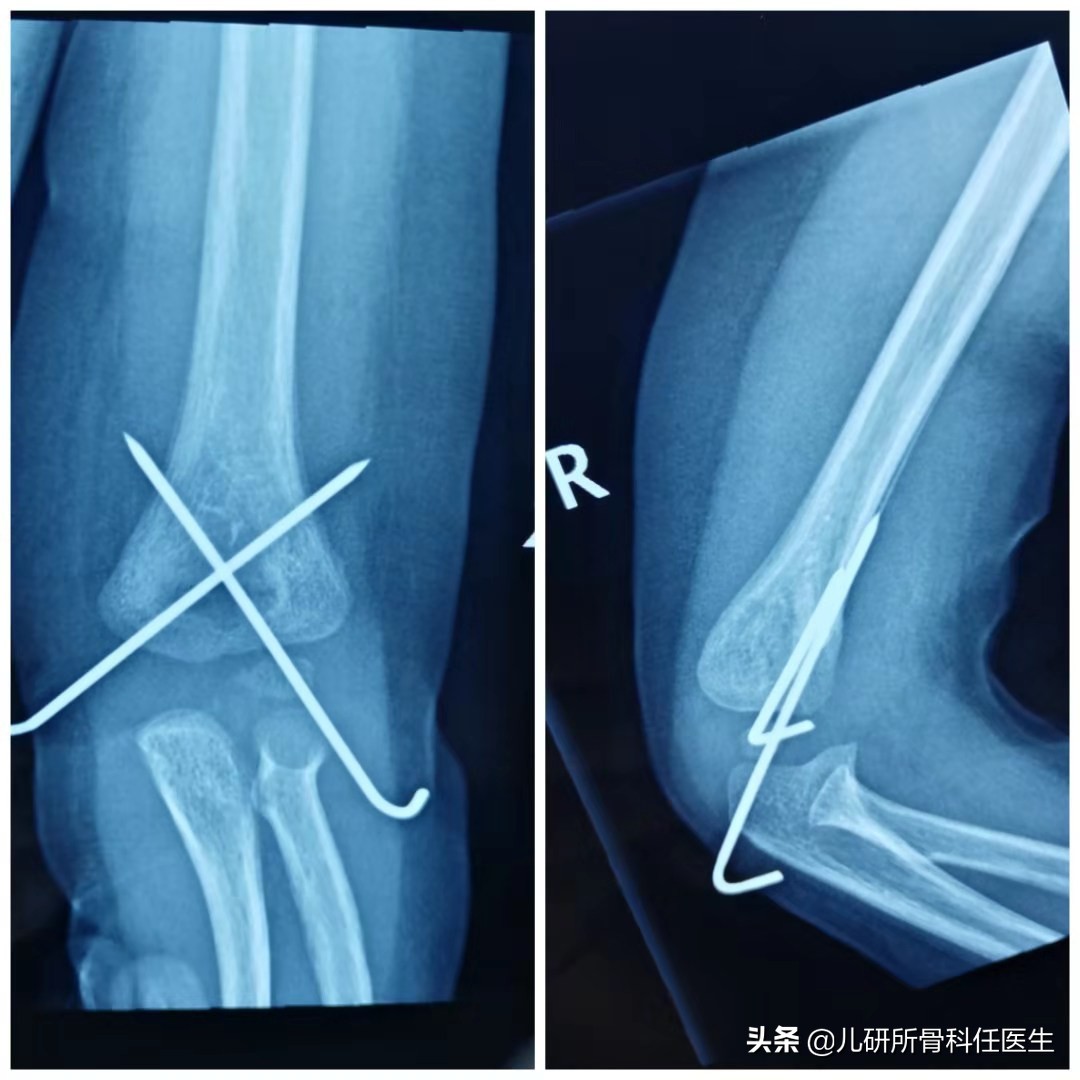 孩子骨折医生说要动手术,骨折康复辟谣