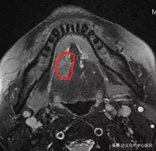 远离舌尖上的致癌物,远离槟榔癌症