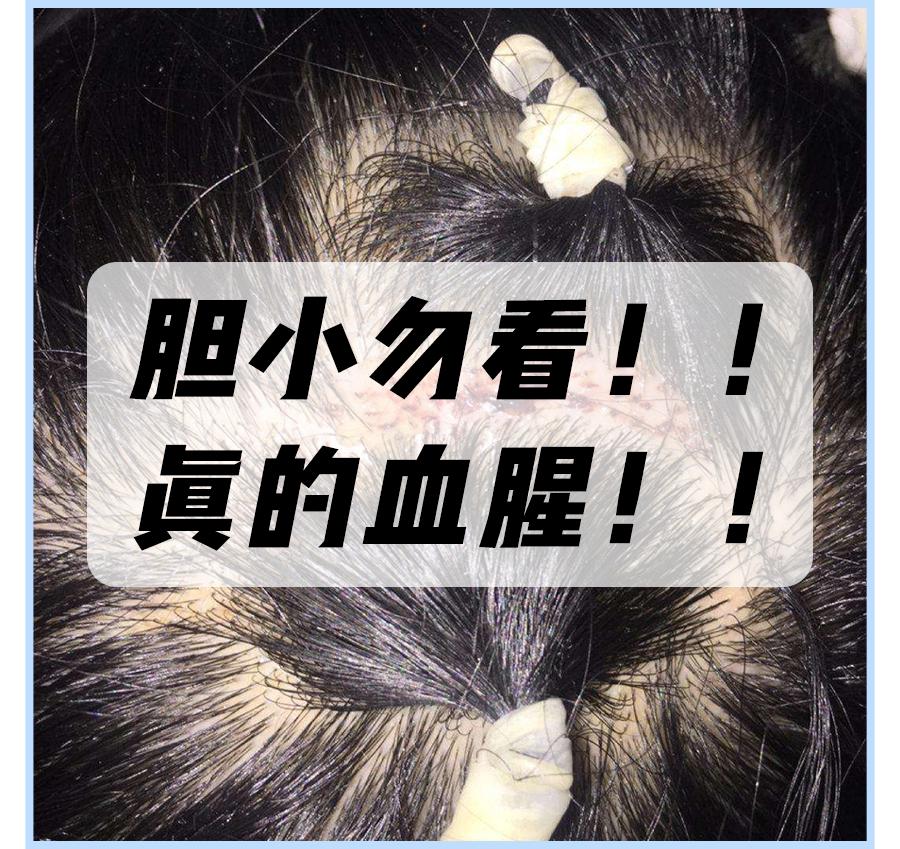 鞠婧祎全身造假,鞠婧祎头皮都整了吗