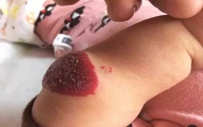 眼角内长的血管瘤破了怎样止血,头皮血管瘤破了止不住血怎么办