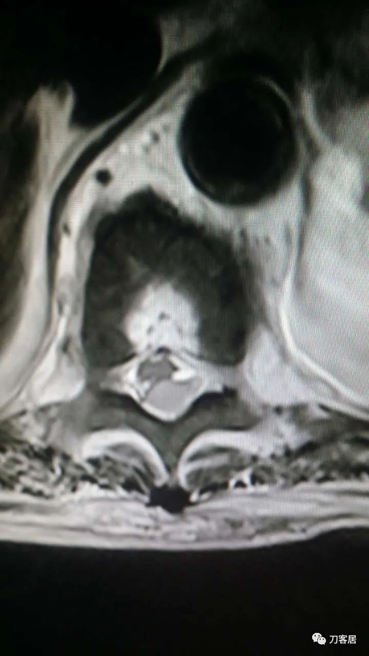 腰椎手术切掉棘突,腰突微创后出血肿