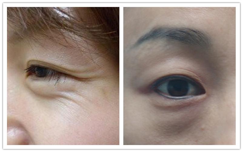 眼部最近出现了细纹怎么办,眼部细纹突然多