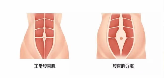 产后肚子回不去，原来是它在作怪，2种修复方法越早知道越好
