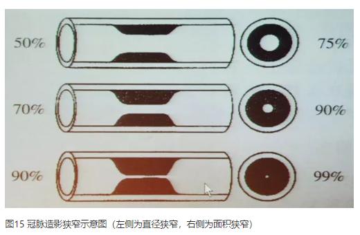 清晰完整揭秘冠脉造影全部过程,冠脉造影教学视频