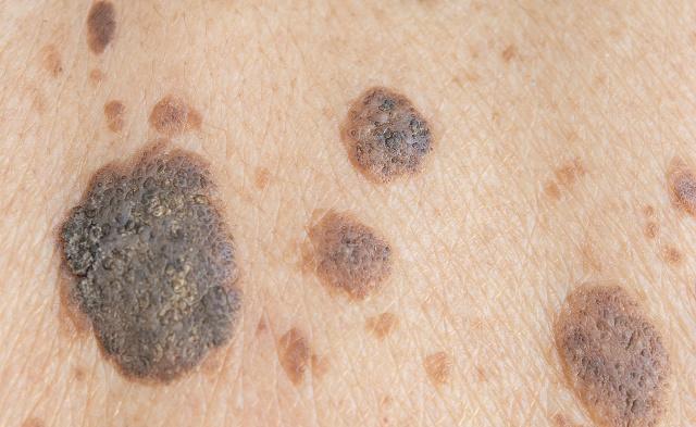 黑色素痣恶化为黑色素瘤的前兆,黑色素瘤会不会危及生命