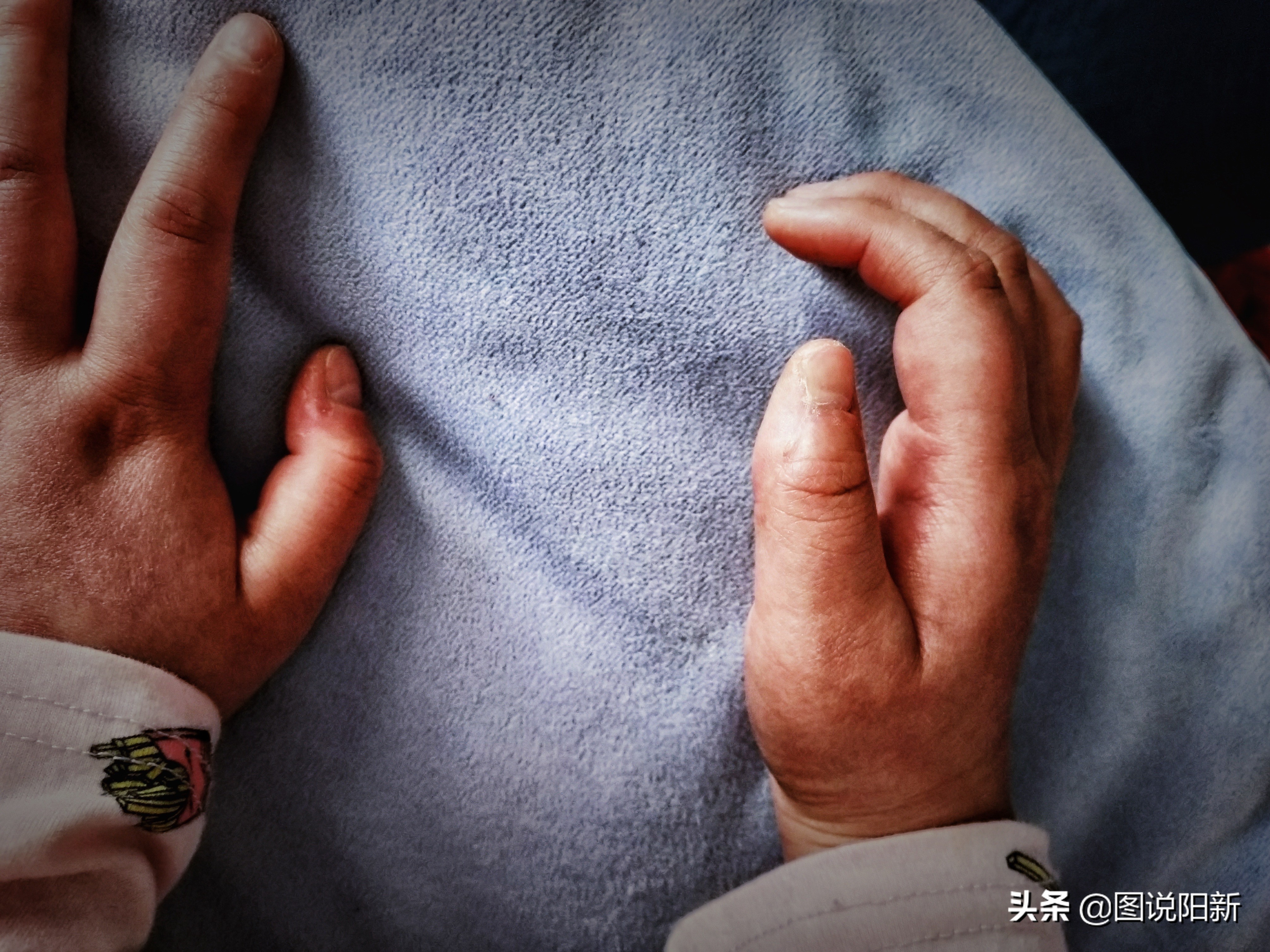 女孩患了200万分之一罕见病,女孩身患罕见怪病