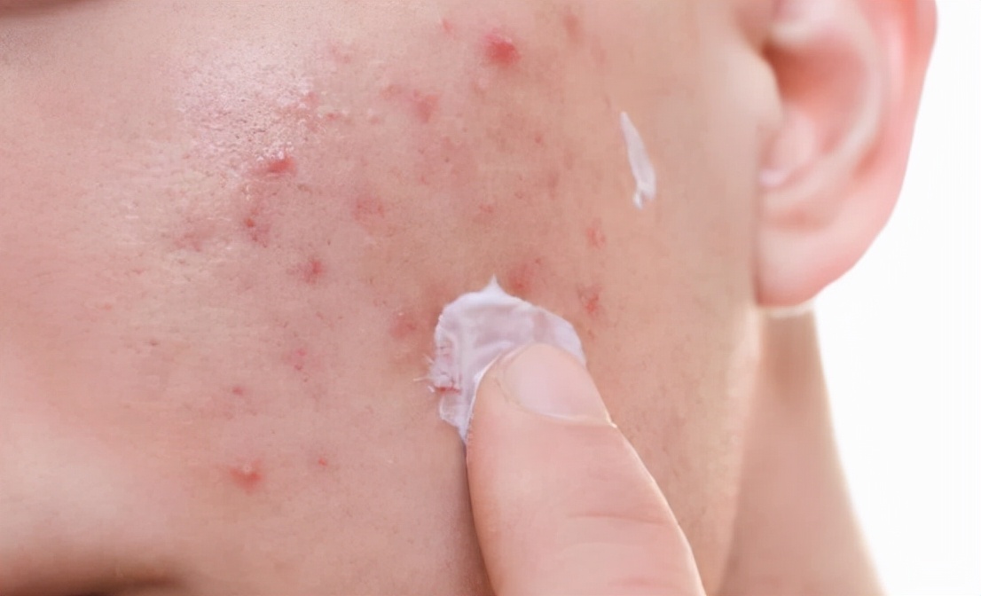 一直长痘留疤怎么办,长痘留疤怎么恢复