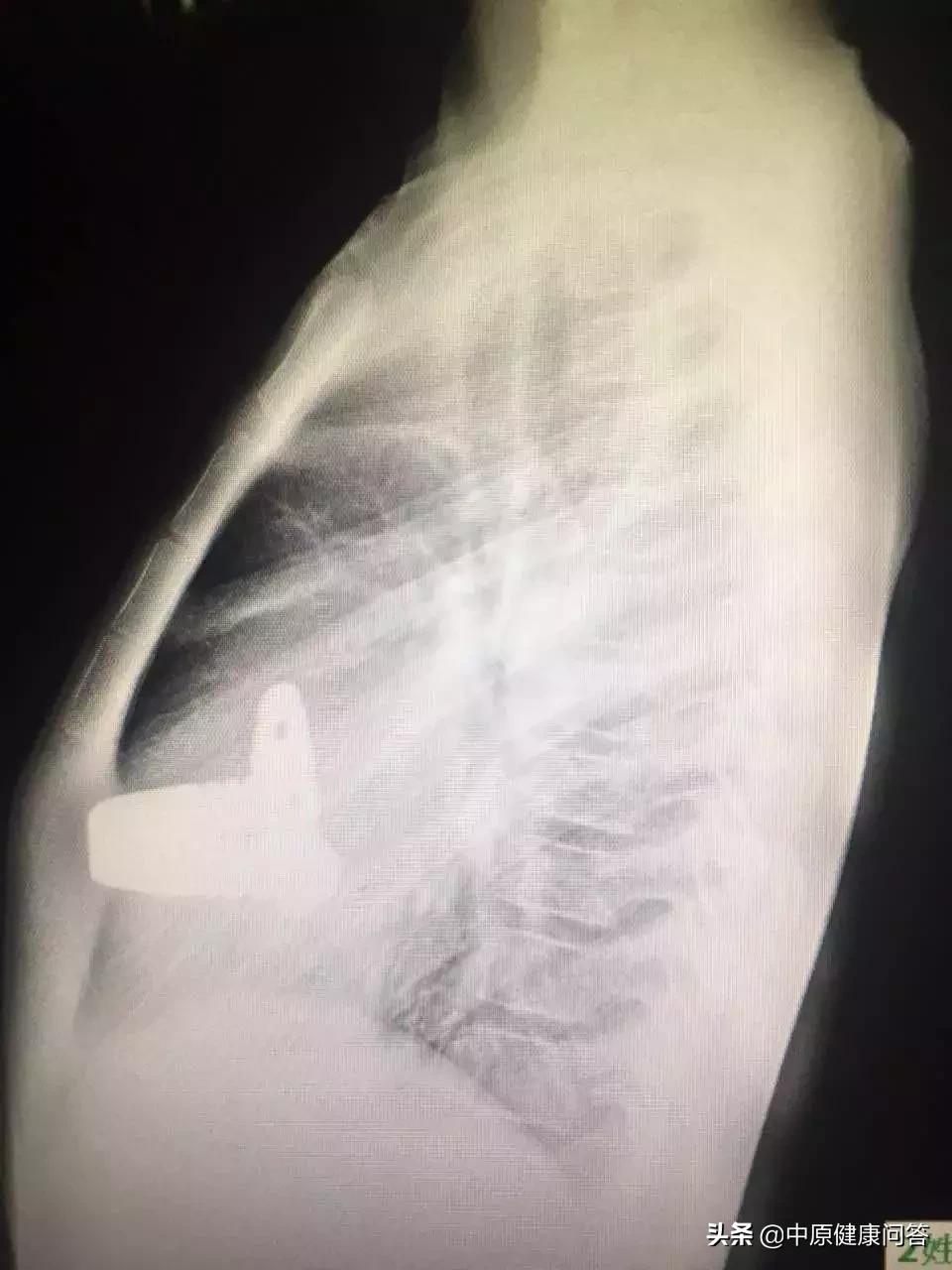 宝宝胸口凹陷地方青了,宝宝胸部凹下去一块是缺啥