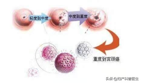 20多岁患宫颈癌的几率,宫颈癌筛查需要做宫颈刮片么