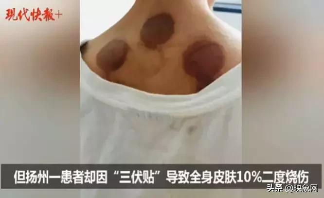 郑州三伏贴哪家好,郑州三伏贴有效吗