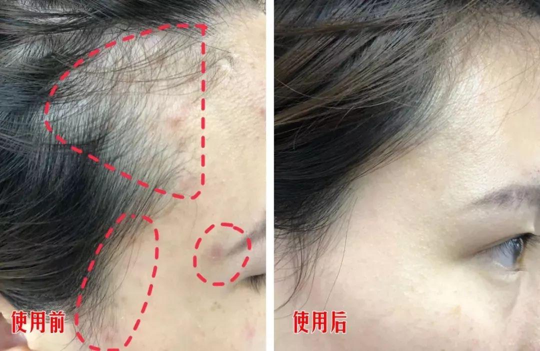 去头屑去螨虫哪个洗发水最有效,去头屑去螨虫用哪个洗发水最有效