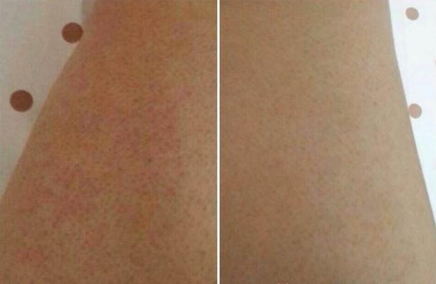 啥方法可以改善鸡皮皮肤,怎么有效去鸡皮肤的小妙招