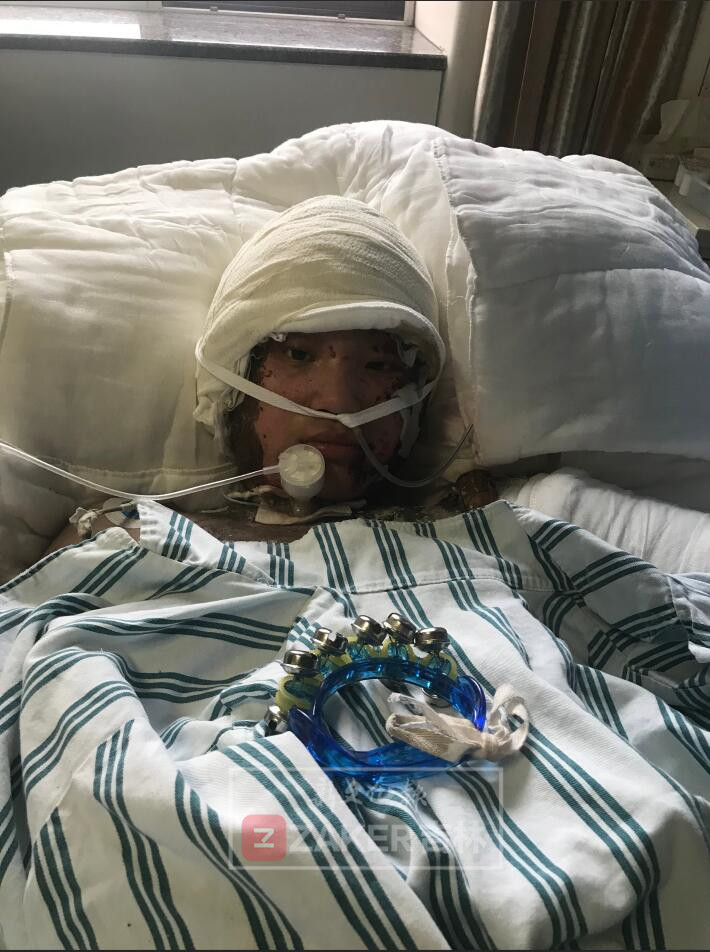 已做完第四次手术状态平稳铭医专家团表示愿意免费帮她修复容颜