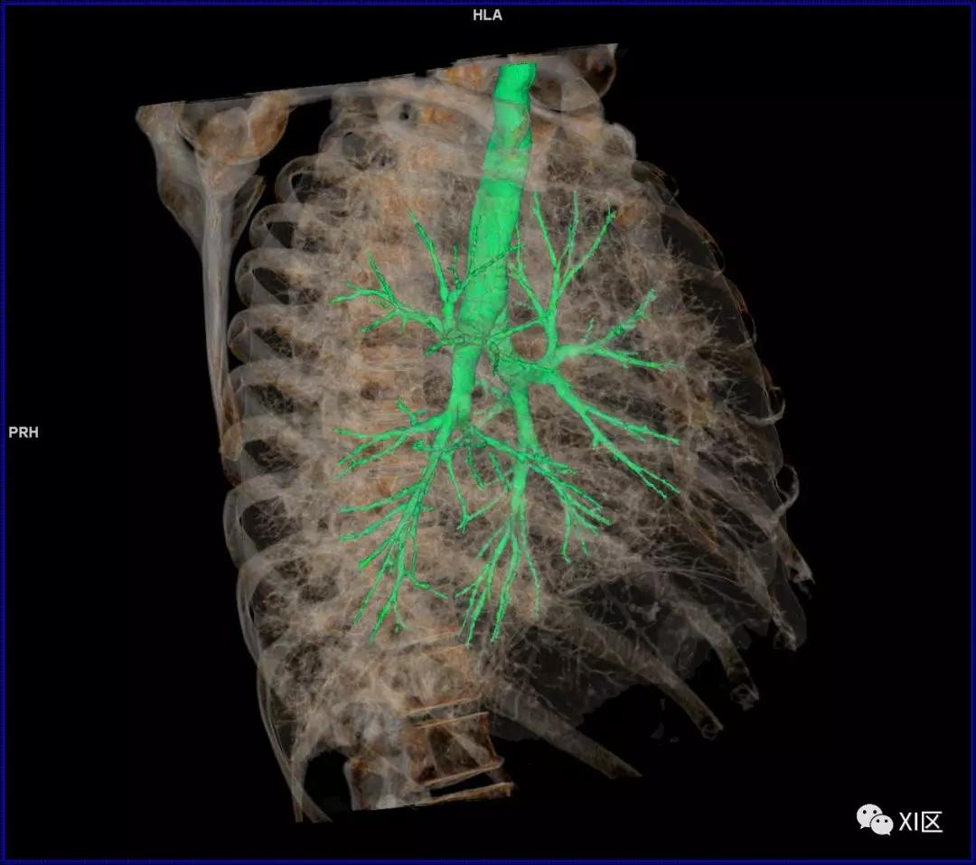 如此详细的肺部影像解剖，有点儿酷