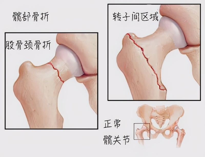 张钧甯素颜现身被*拍偷**！憔悴形象非常瘦，一双大长腿撑不满裤管