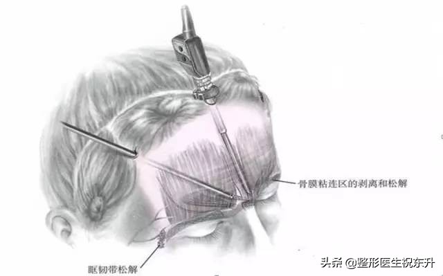 内窥镜除皱术术前术后对比,内窥镜除皱术