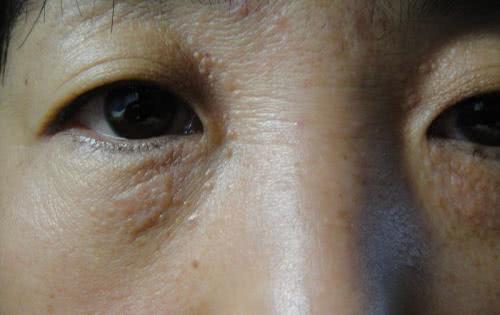 为什么眼白会有色素斑,为什么眼白上有红血丝和黑点