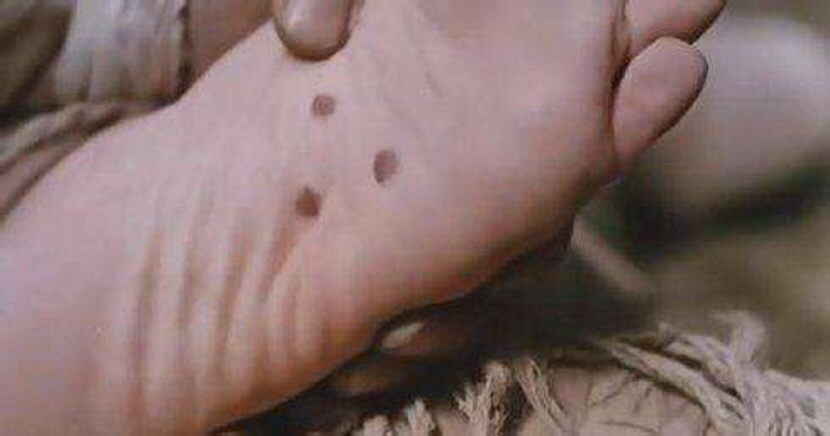 医生忠告四不做,医生提醒这几种痣要警惕