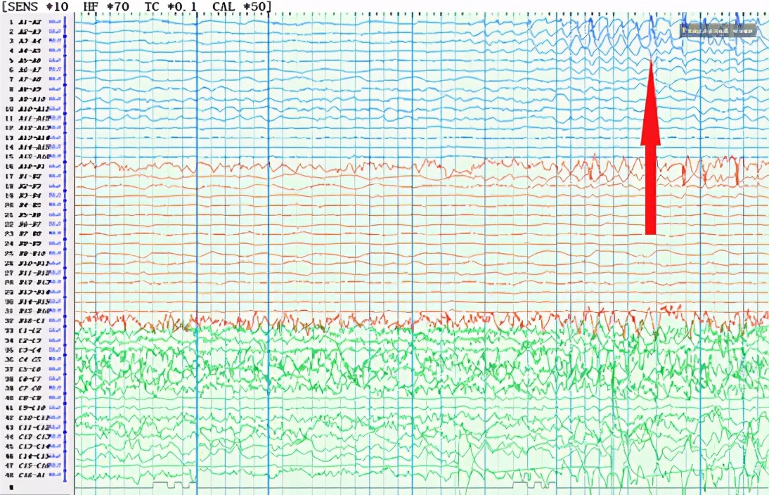 良性癫痫会痴笑发作吗,痴笑性癫痫是什么