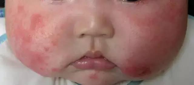 家长还在为婴儿长湿疹苦恼？李医生给您支招