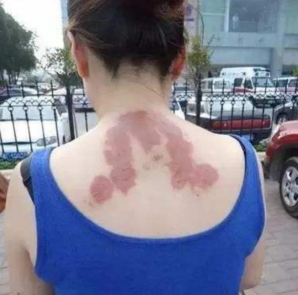 贴三伏贴起水泡是怎么回事,三伏贴起水泡为什么是黄色的