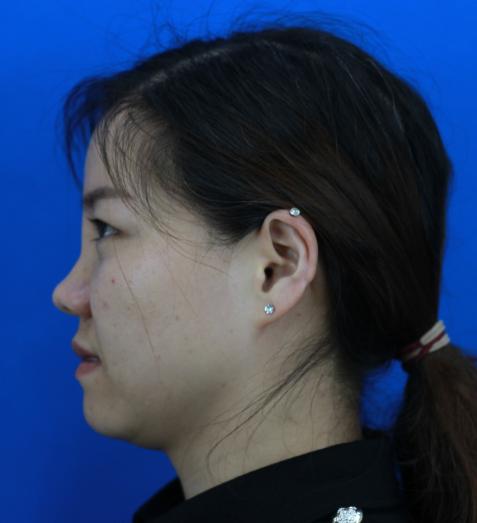 网红鼻子修复效果图,鼻整形多久可以修复