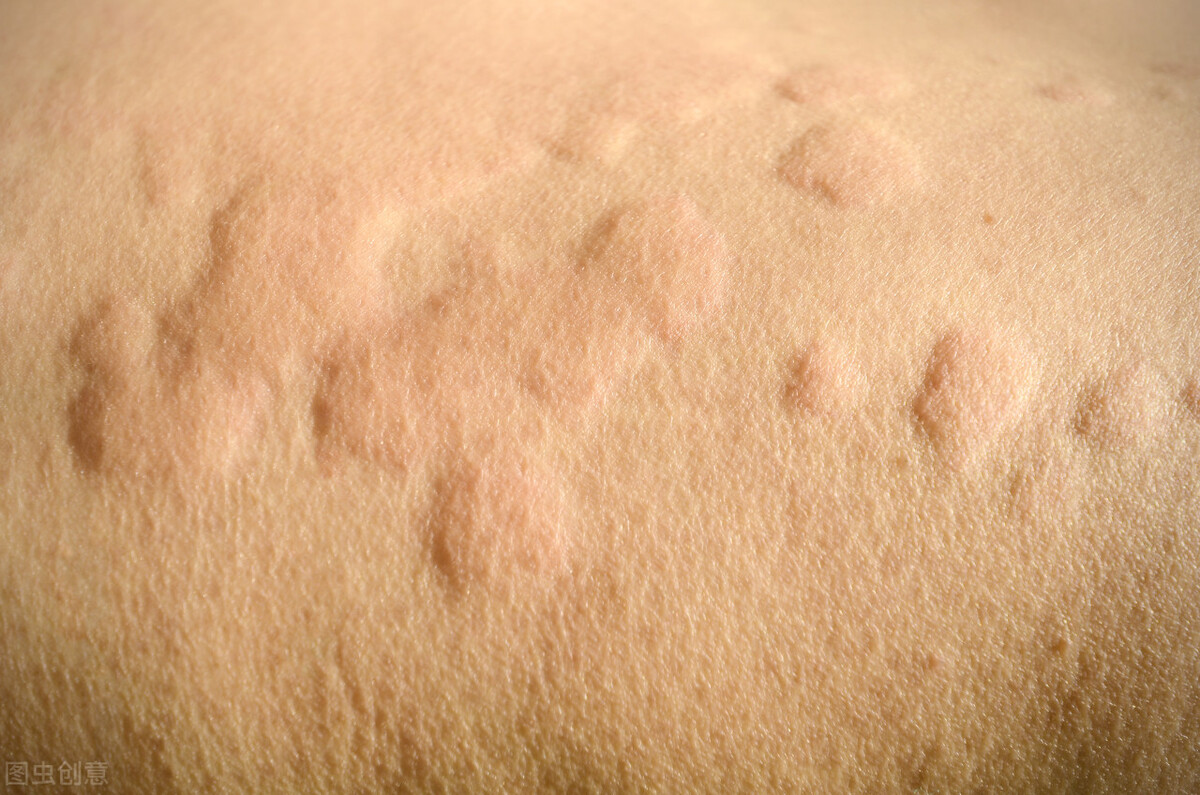 中药治疗荨麻疹止痒最有效方法,麻疹痒止痒妙招