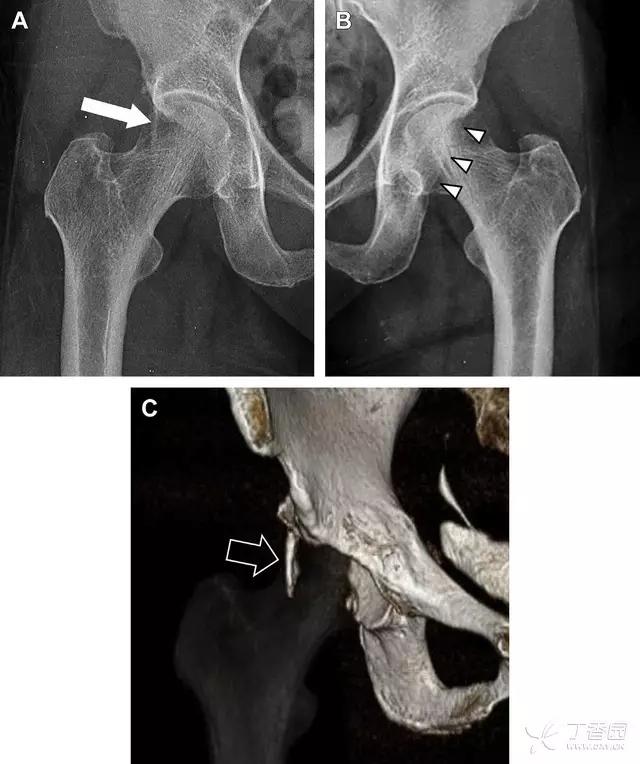 放射科夜班病例大全,放射科容易漏诊的骨折