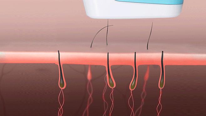 体毛脱毛的最佳方法,体毛怎么脱毛最快最有效