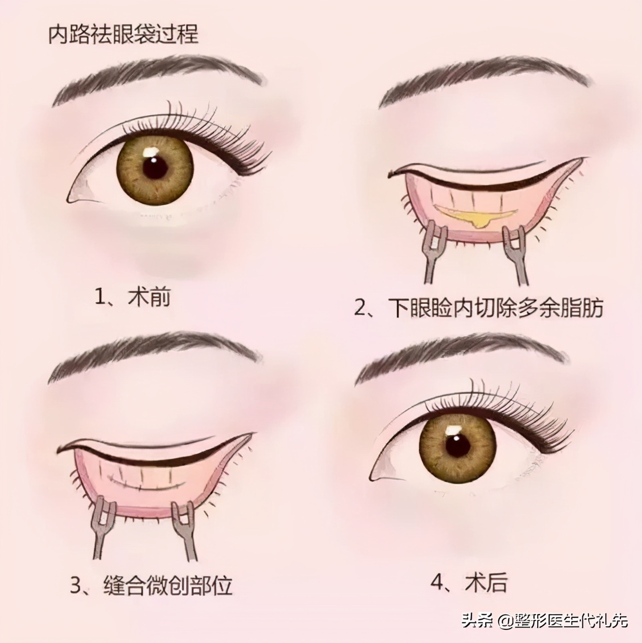 问一下有什么方法快速消除眼袋,关于眼袋的去除方法