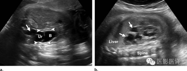 孕期发现卵巢囊肿有8cm左右,孕19周查出胎儿卵巢囊肿