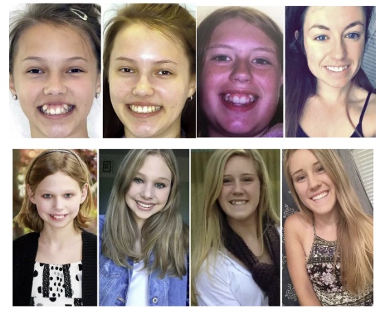 王俊凯整牙日记完整版,王俊凯的小虎牙为什么磨平了