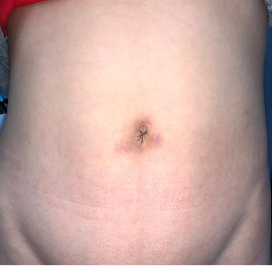 睾丸精索静脉曲张微创手术全过程,睾丸精索静脉曲张手术微创