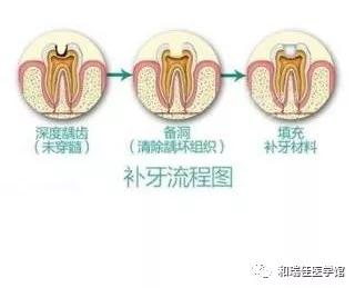 补牙与根管治疗需要多少钱,补牙与根管治疗的区别