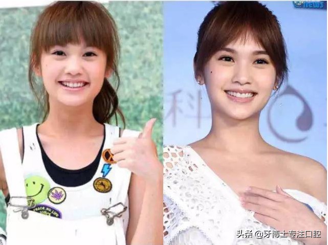 明星牙齿矫正前后对比,明星牙齿矫正都用的什么矫正方式