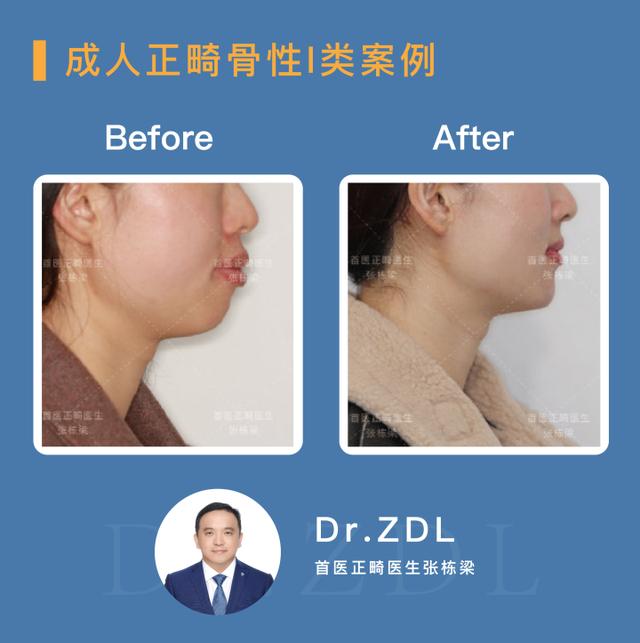 骨性龅牙做正畸还是正颌,骨性龅牙正颌手术前要正畸吗