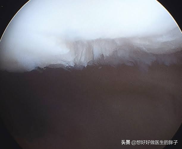 髌骨软骨损伤膝盖总是咔咔响,膝盖损伤后髌骨响是什么原因